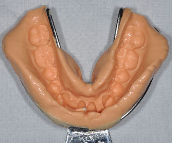 Samit Metallic Dentulous Perforated Impression Tray - L2
