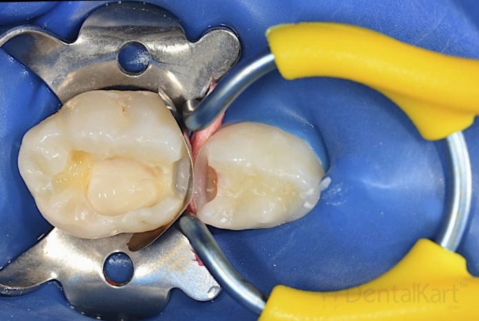 Waldent Rubber Dam Clamps Pedo