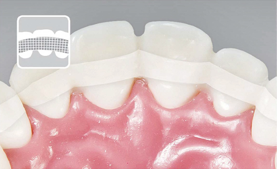 Inod U.P Fiber Splint