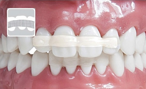 Inod U.P Fiber Splint