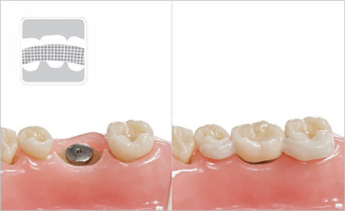 Inod U.P Fiber Splint