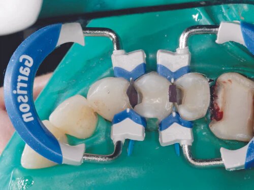 Garrison Dental Composi-Tight 3D Fusion Matrix Rings 