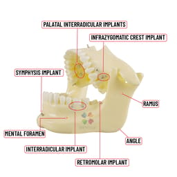 iDENTical Orthodontic Implant Model - M2016 - 9
