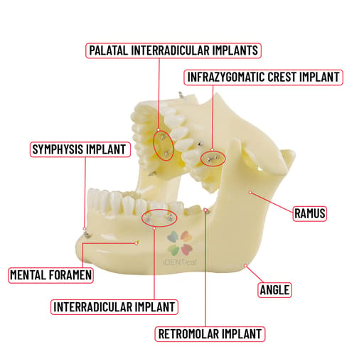 iDENTical Orthodontic Implant Model - M2016