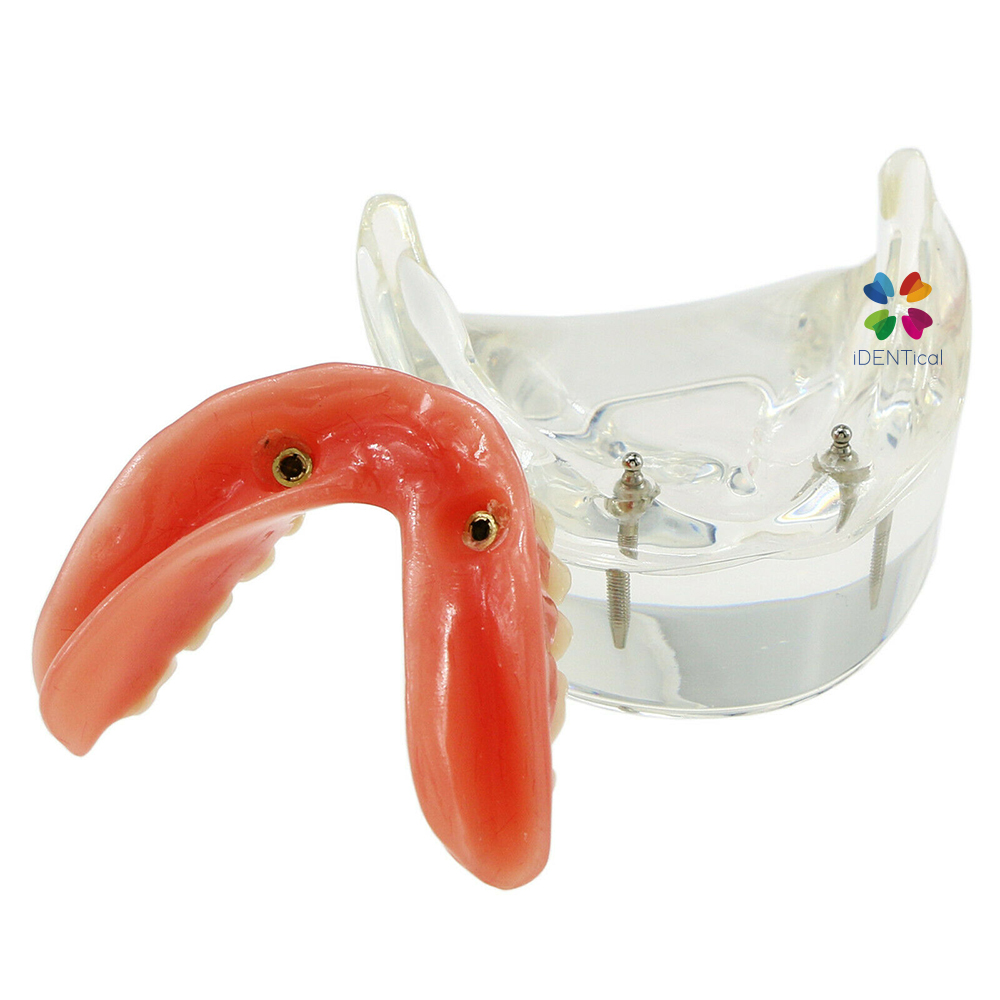 iDENTical Mandibular Overdenture Model with 2 Implants M6002