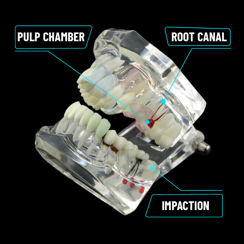 iDENTical All In One Dental Implant Model - M2001 (White)