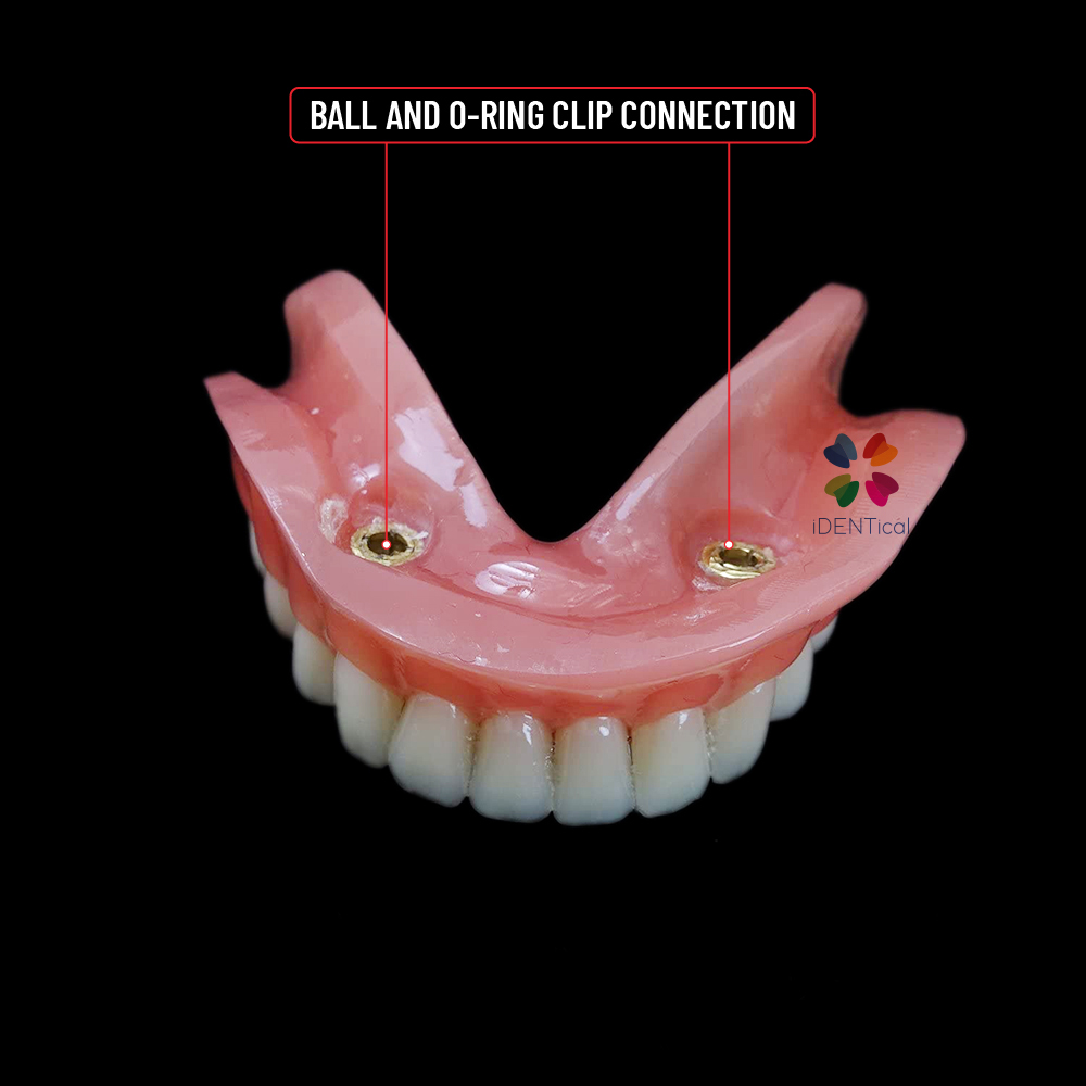 iDENTical Mandibular Overdenture Model with 2 Implants M6002