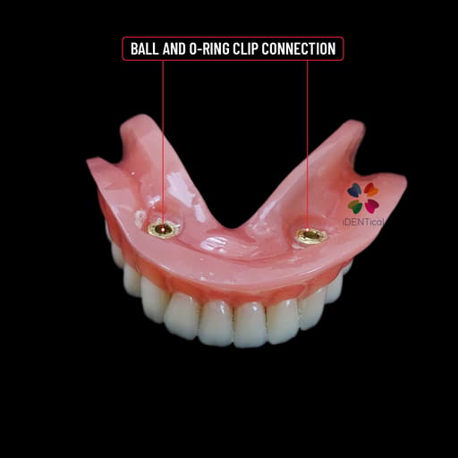 iDENTical Mandibular Overdenture Model with 2 Implants M6002