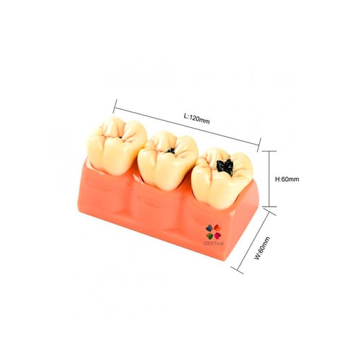 iDENTical Caries Development Tooth Model M4020