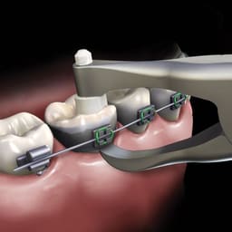 Waldent Posterior Band Remover Long TC 10/104 - 7