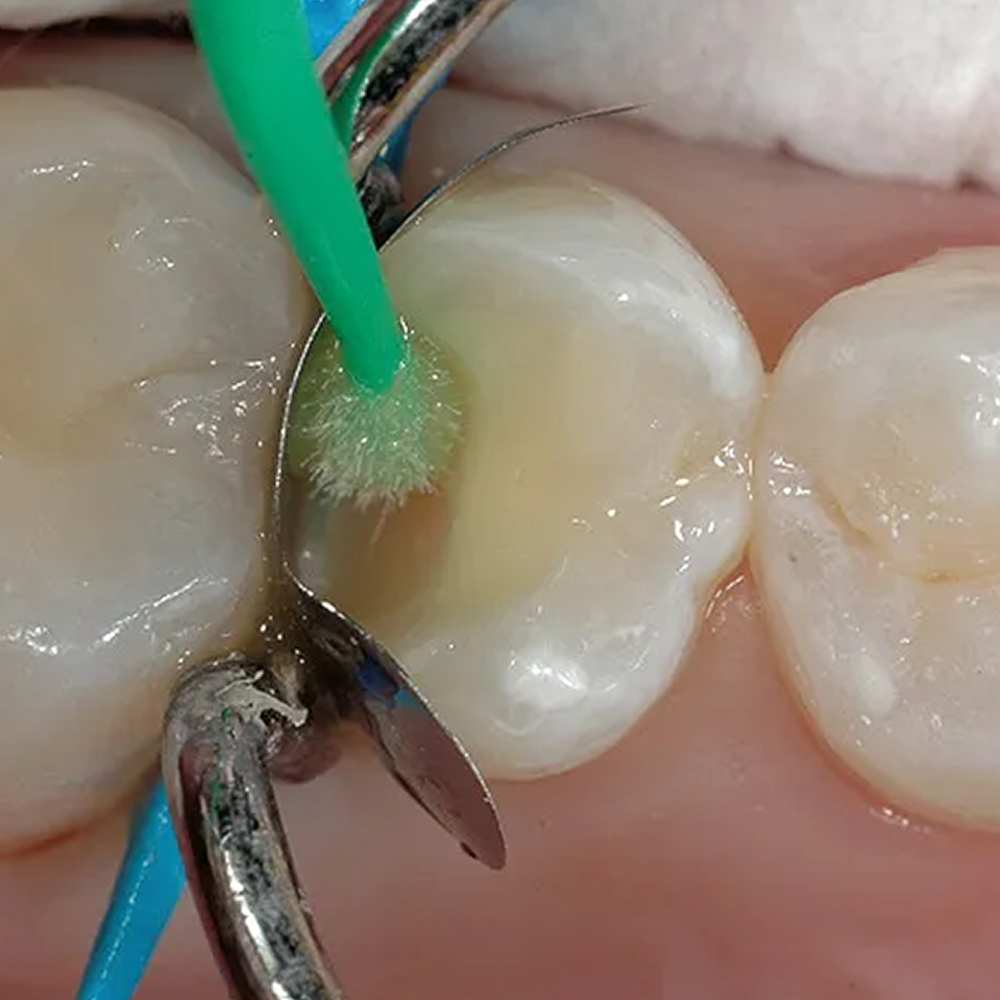 Prime Dental Restorite Bond 5G