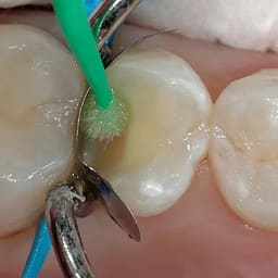 Prime Dental Restorite Bond 5G - 4