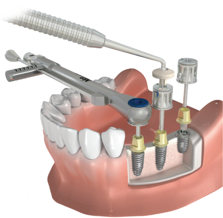 Dental Implant Prosthetic Universal Kit