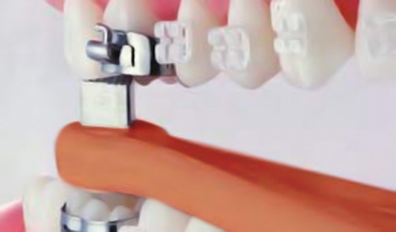 Waldent Band Seater (60/108)