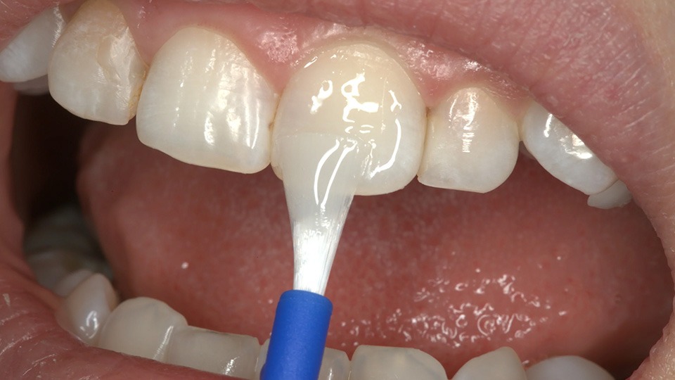 Medicept Soloeze Densensitizing Agent