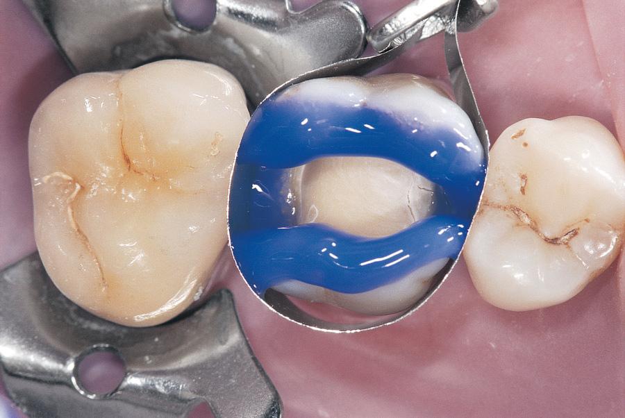 D-Tech Dental Etch Etching Gel (Dropper Pack)