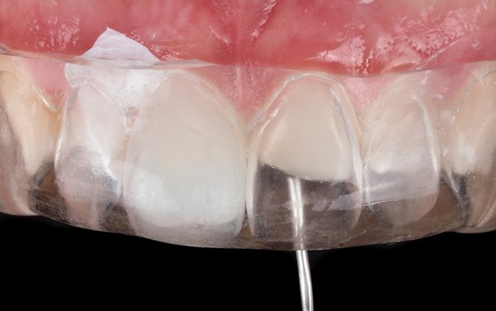 Waldent Alchem Nanoflow Zirconium Flowable Composite