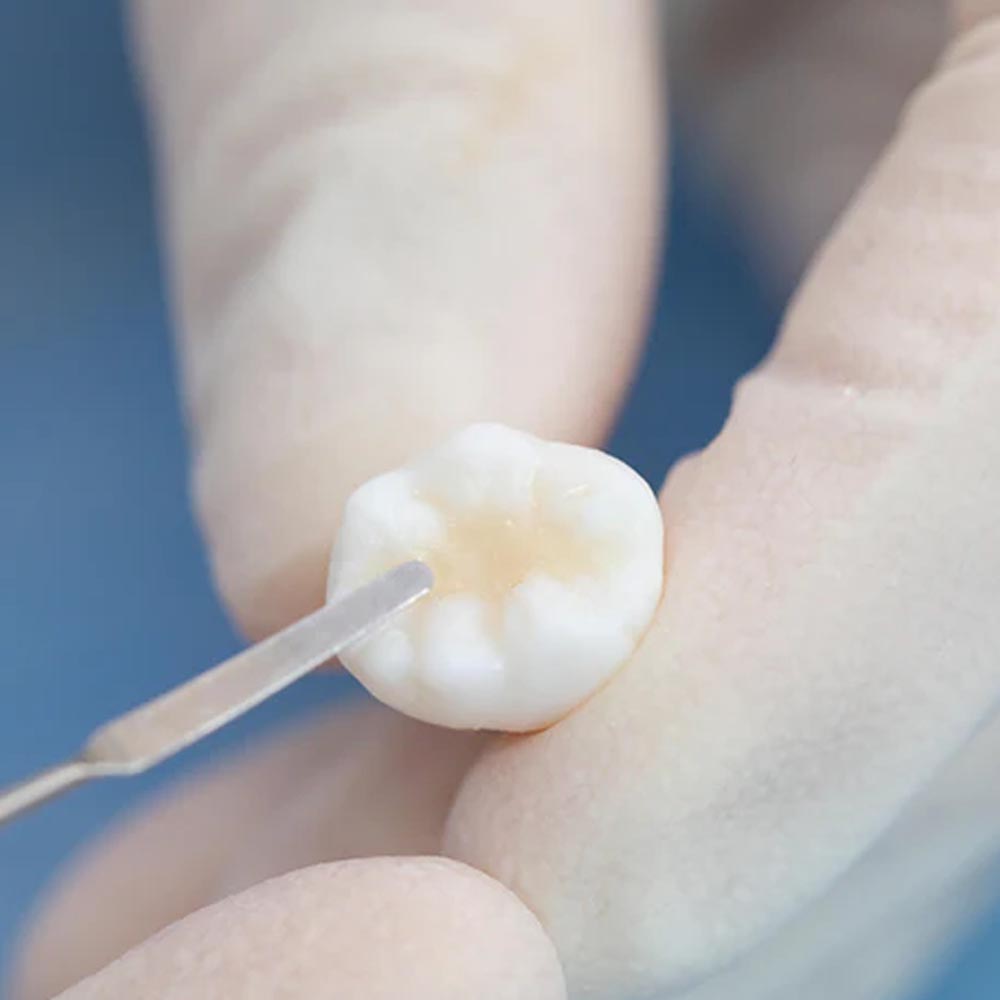 Vincismile Trusfil Universal Composite