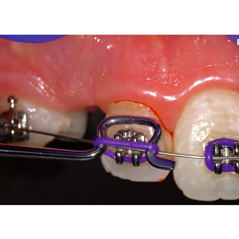 GDC Ortho Elastic Ligature Applicator #1 (674)