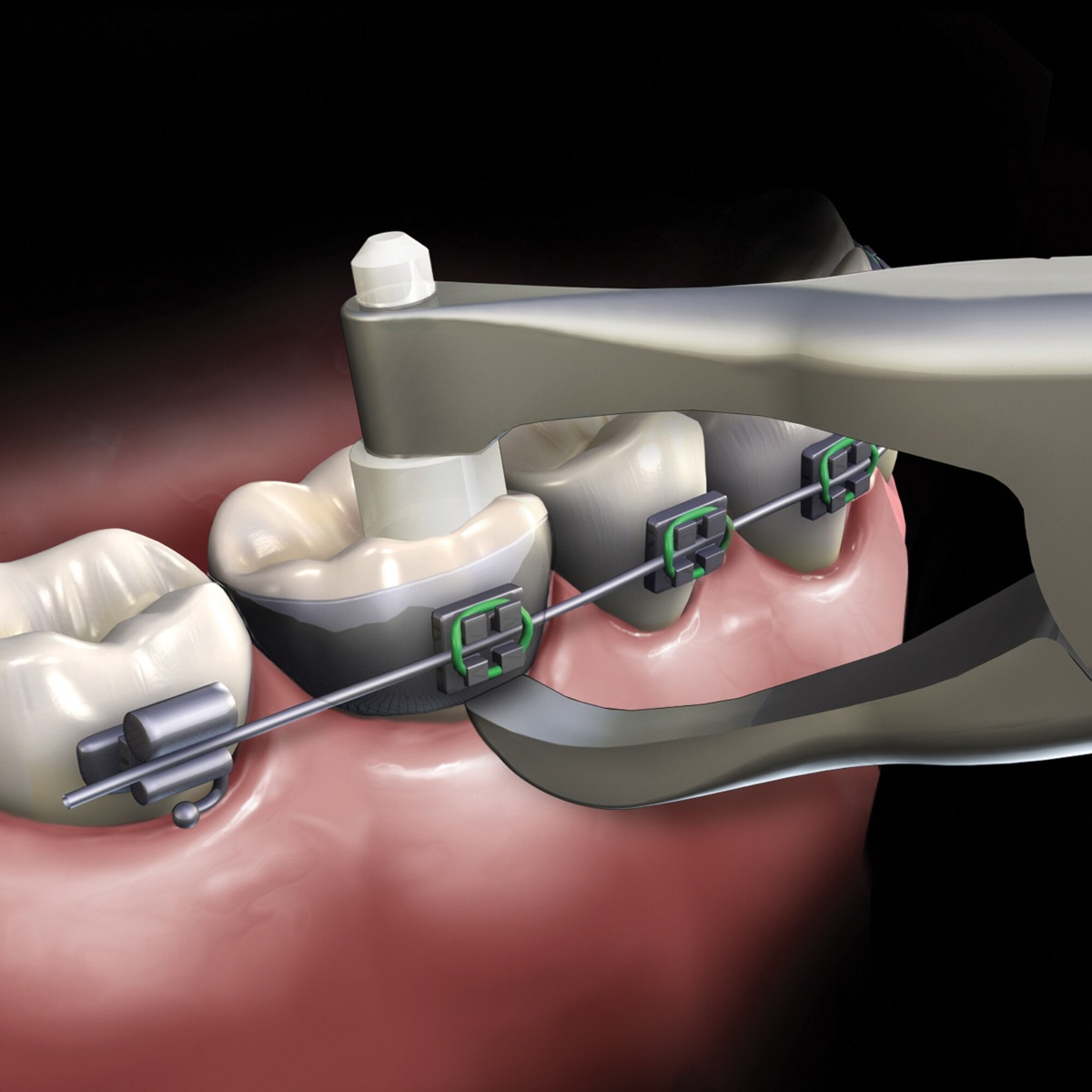OSL Posterior Band Remover Plier