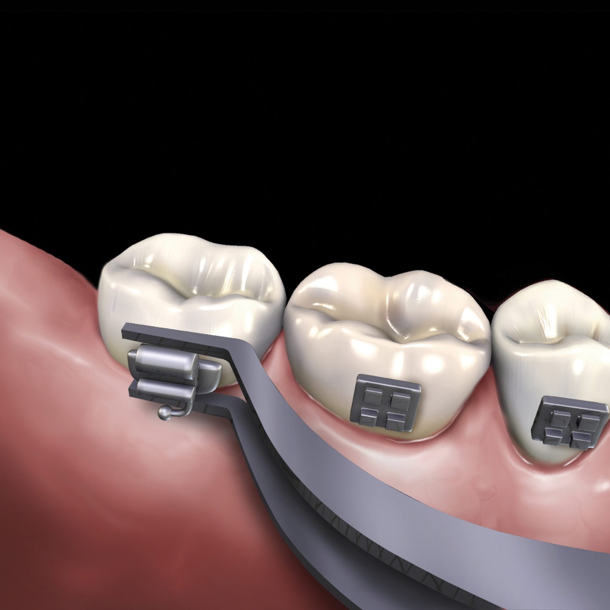 GDC Buccal Tube Holder (1134)