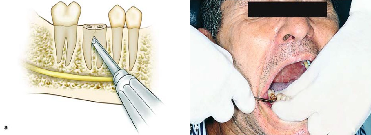 Waldent Root Elevator Instruments Kit Set of 11 K2/4