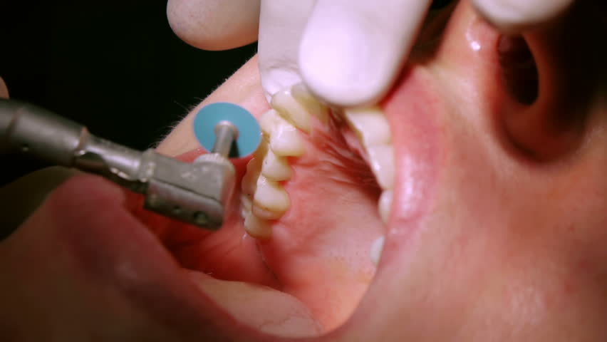 ET Dental Polishing Discs With Rivets Kit