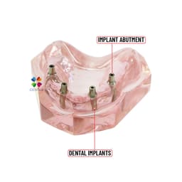 iDENTical Dental Model for Overdenture Maxilla M6001 - 10