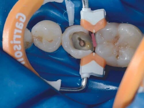 Garrison Dental Composi-Tight 3D Fusion Matrix Rings