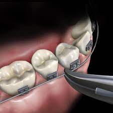 Waldent Weingart Plier TC 10/105