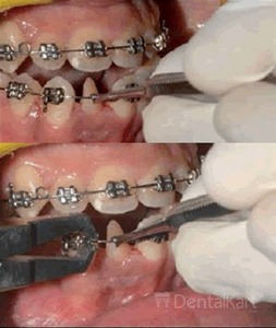 Waldent Orthodontic Kit Classic Set of 11 (K10/2)