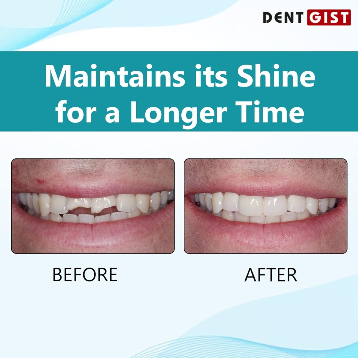 DentGist NanoCom Restorative Composite Refills 4g