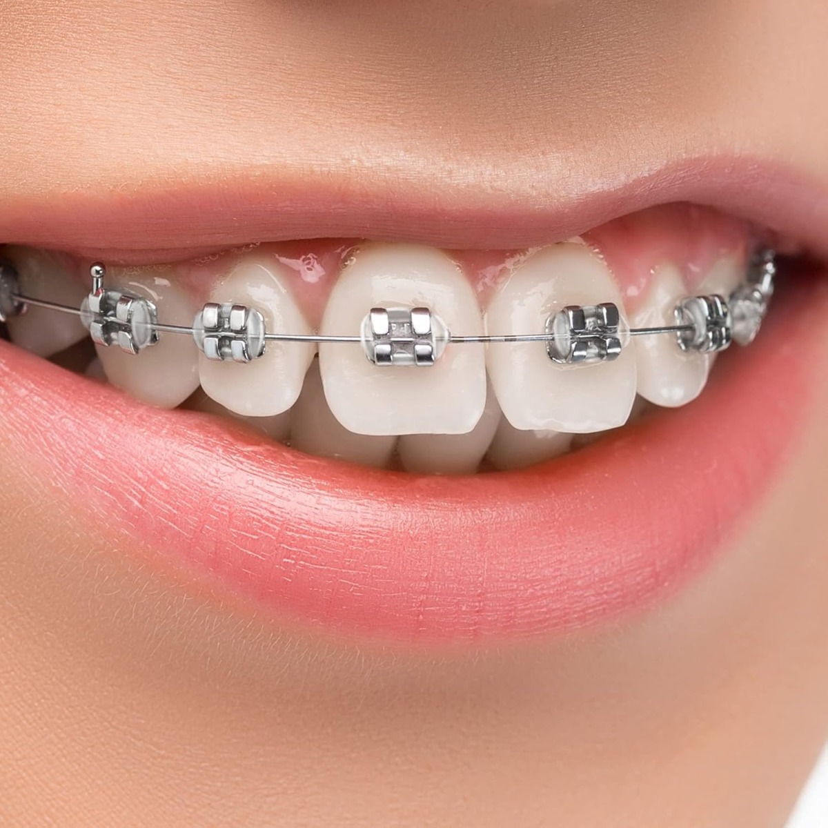 UU Ortho Classic Metal Brackets MBT 0.22