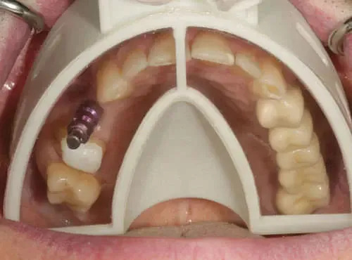 Cotisen Implant Impression Tray Insert Refills
