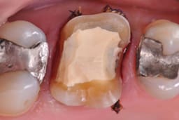 Septodont Biodentine Kit ( Pack of 5 capsules ) - 11