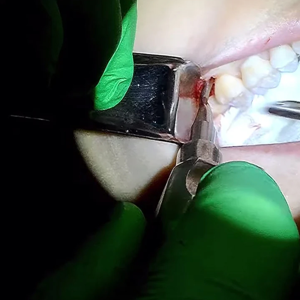 VeeCare 77 Surgical Elevator