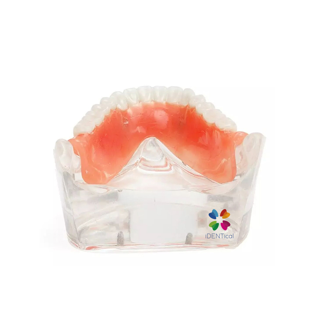 iDENTical Mandibular Overdenture Model with 2 Implants M6002