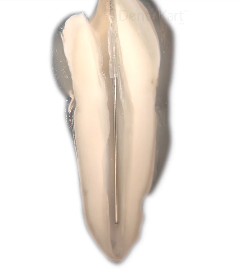 Waldent MTA Carrier 13cm