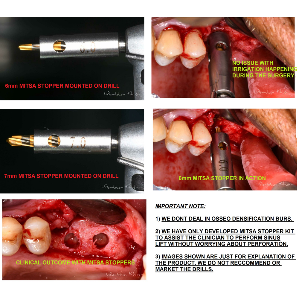 Julldent Mitsa Stopper For Osseodensification Burs
