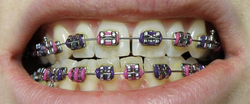 JJ Ortho Orthox Metal Bracket Kits