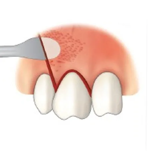 GII Periosteal Elevator