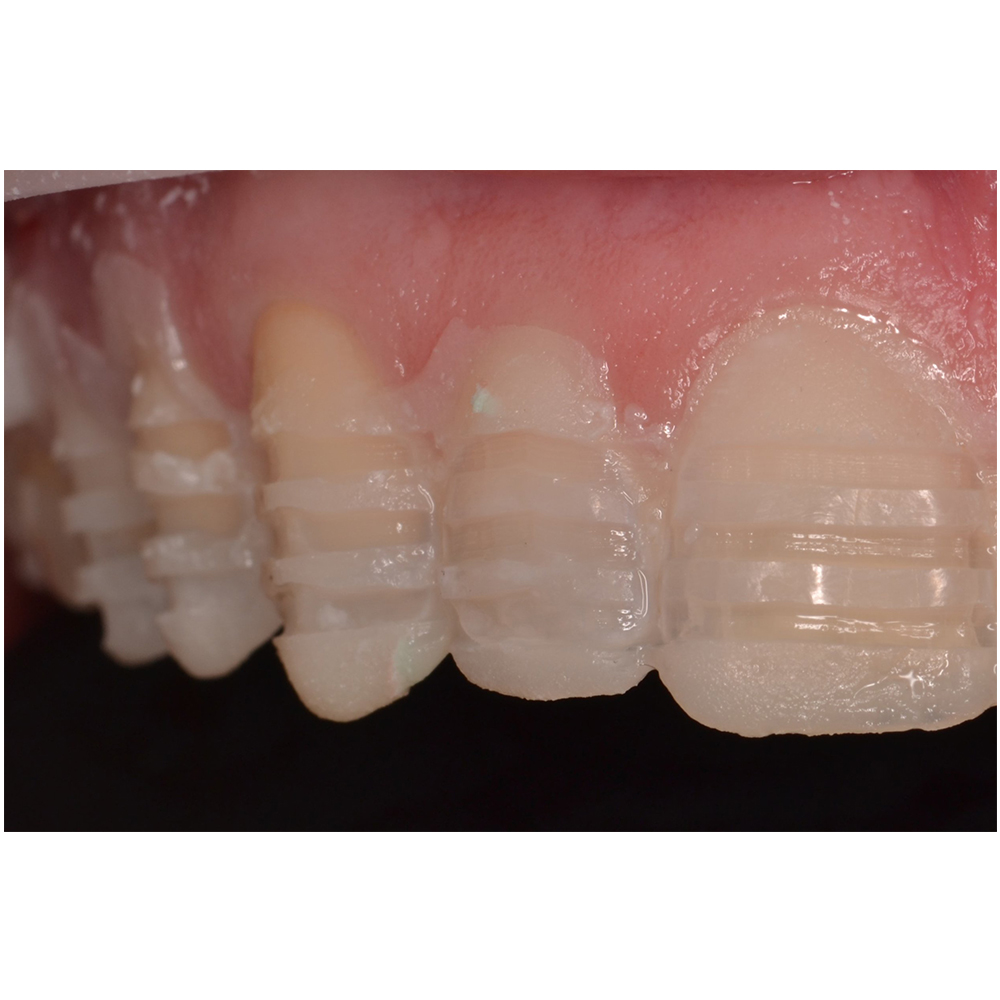 Prima Dental Diamond Depth Cutting Burs