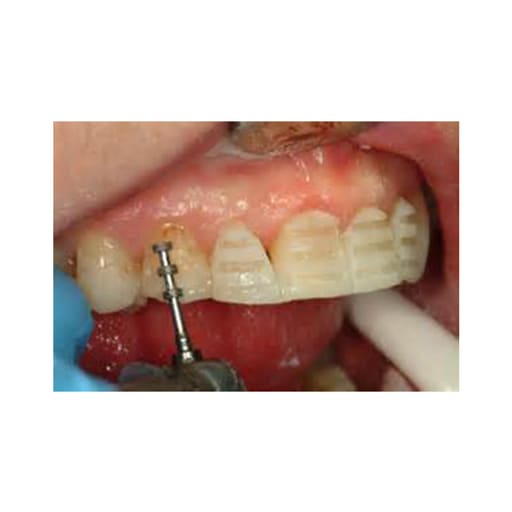 Prima Dental Diamond Depth Cutting Burs