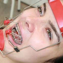 OrthoMetric Elastomerics Extraoral Latex Elastics - 6