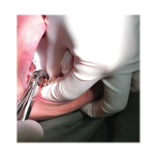 GDC Extraction Forceps Lower Molars - 86C Premium (FX86CP)