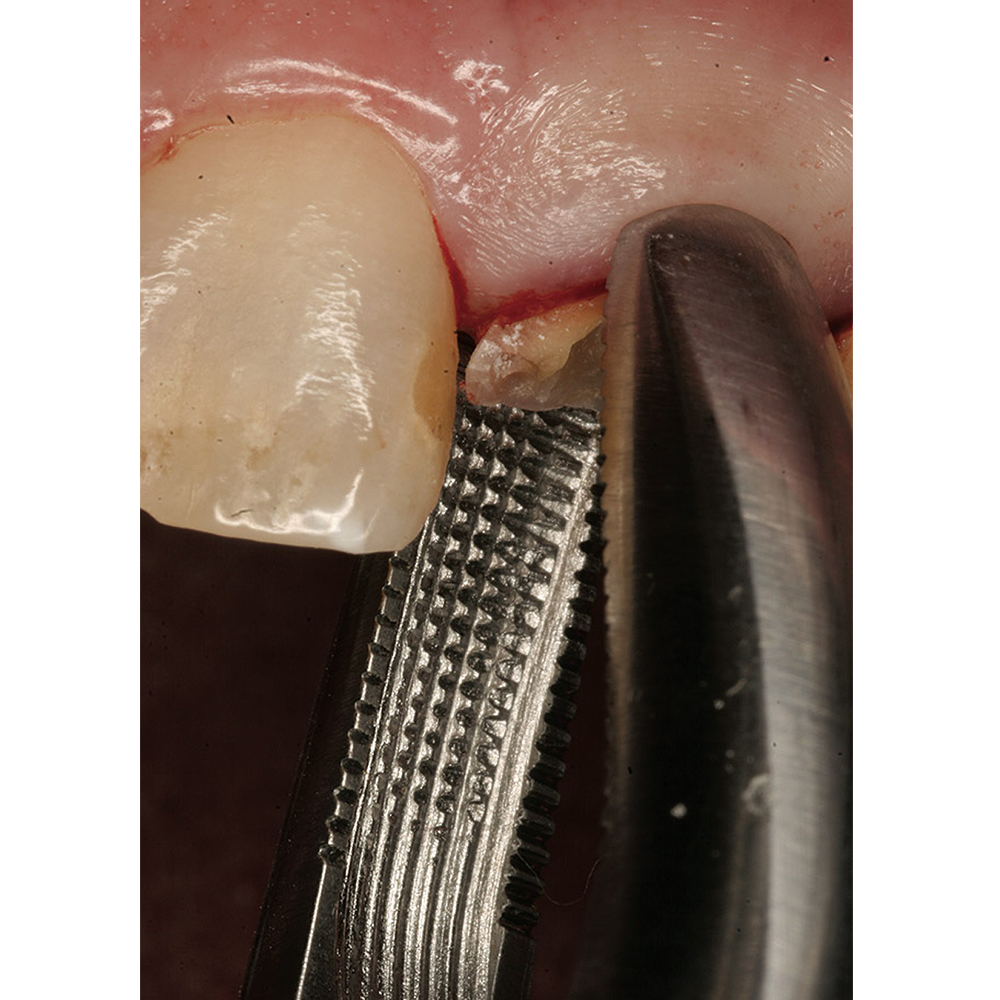 GDC Extraction Forceps Upper Roots - 897.00 Secure (SFX897.00)