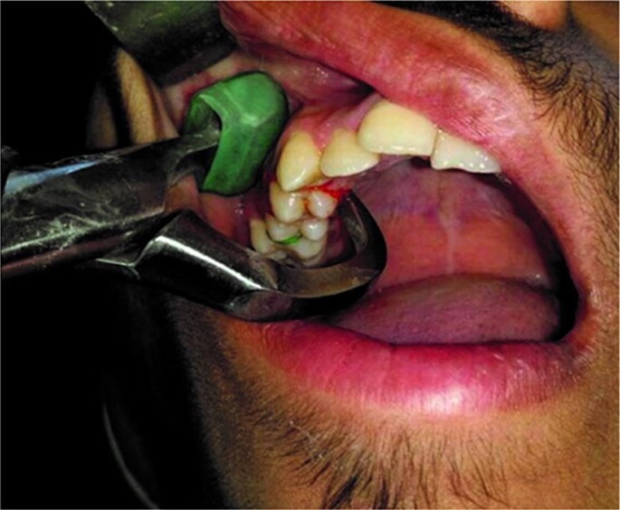 Waldent Physics Forceps Set of 5 (K1/3)