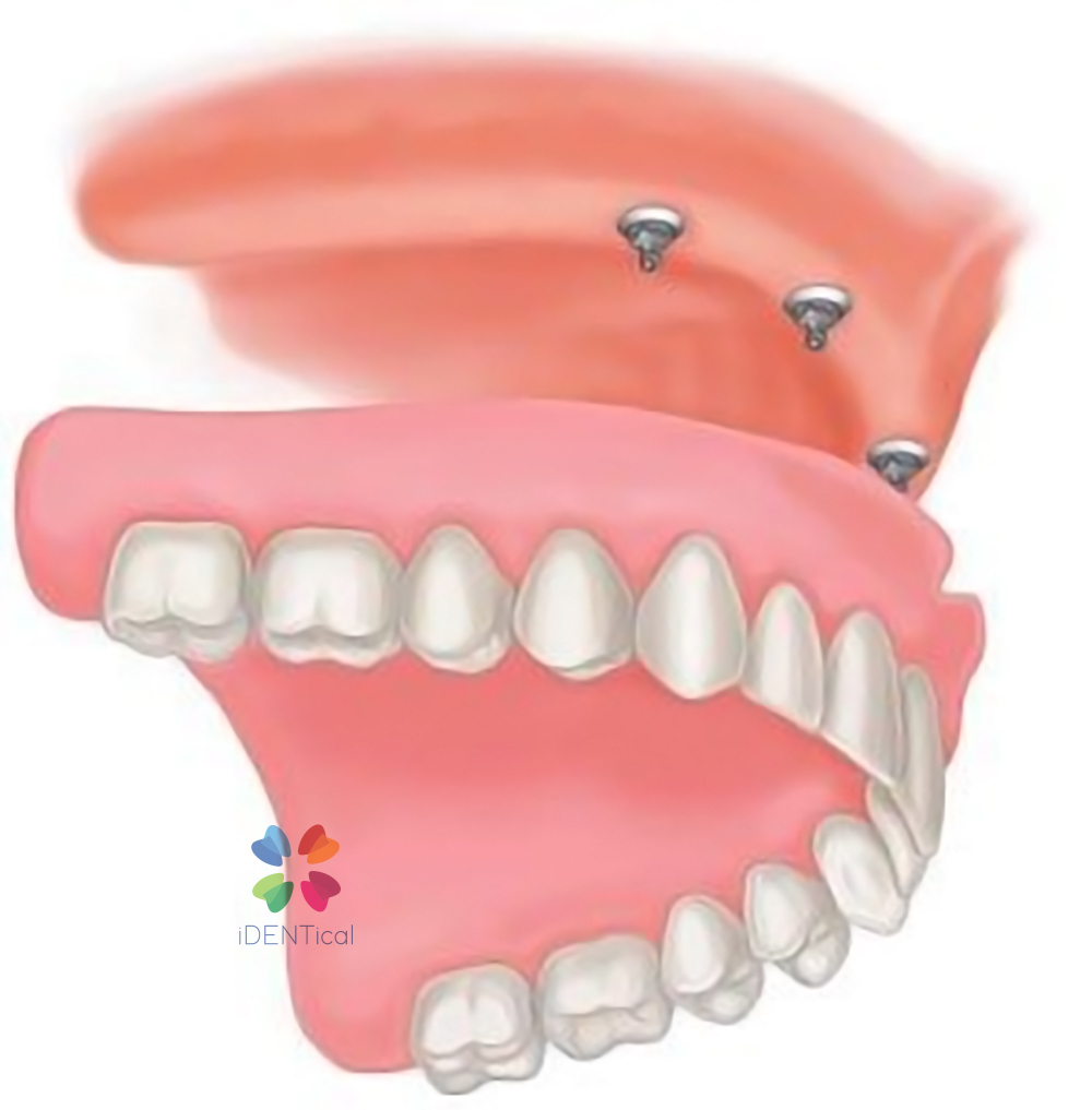 iDENTical Dental Model for Overdenture Maxilla M6001