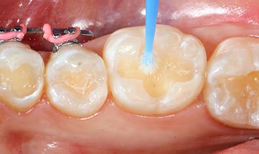 ET Dental Applicator Tips - Regular 