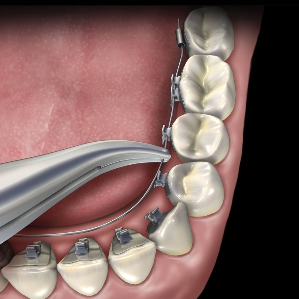 Waldent Orthodontic Kit Classic Set of 11 (K10/2)